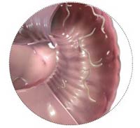 hookworm_middle