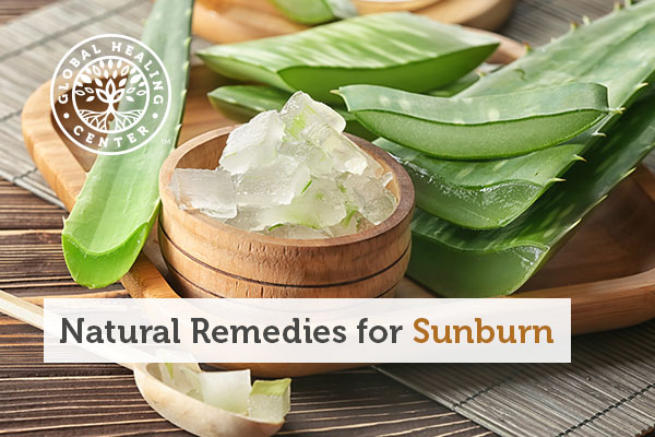 sunburn-remedies