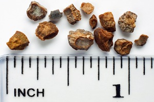 kidney-stones-small