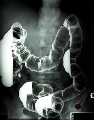 colon-xray-with-barium