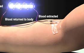 Ultraviolet Blood Irradiation Therapy