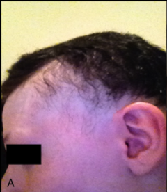 alopecia1