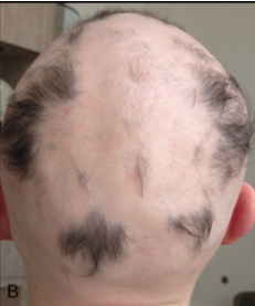alopecia2