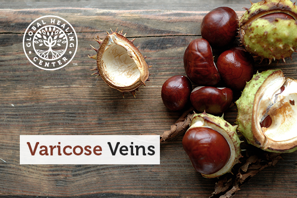 varicose-veins