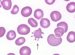 acanthocytes-in-bright-field