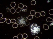 platelet-aggregation-in-darkfield