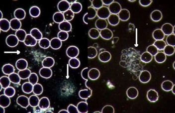 platelet-aggregation-in-live-blood-in-dark-field