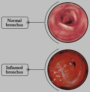 bronchus-normal-vs-inflamed