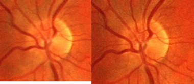 pericorneal-arterioles-capillares-01