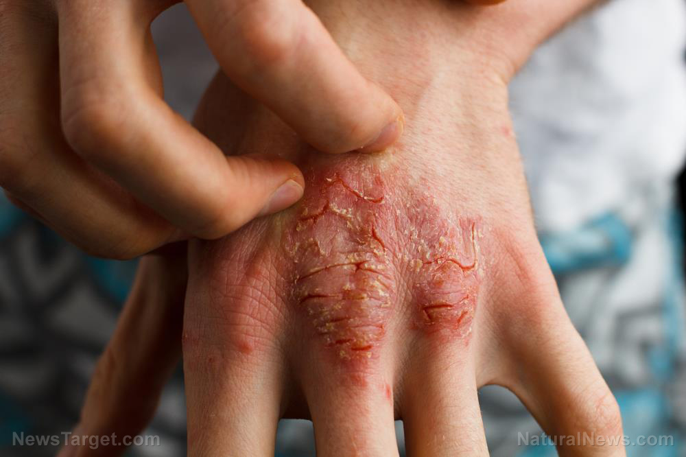 Psoriasis-Eczema-Treatment-Adult-Dermatology-Flaky-Itchy