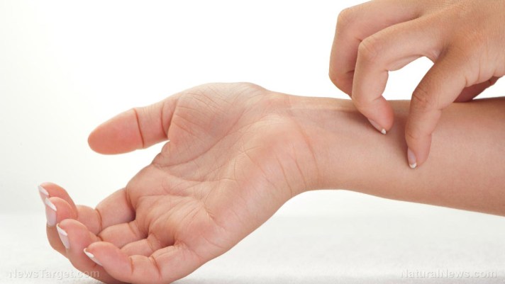 Men jabbed with Moderna’s mRNA COVID injection are at heightened risk of developing chronic hives, study finds