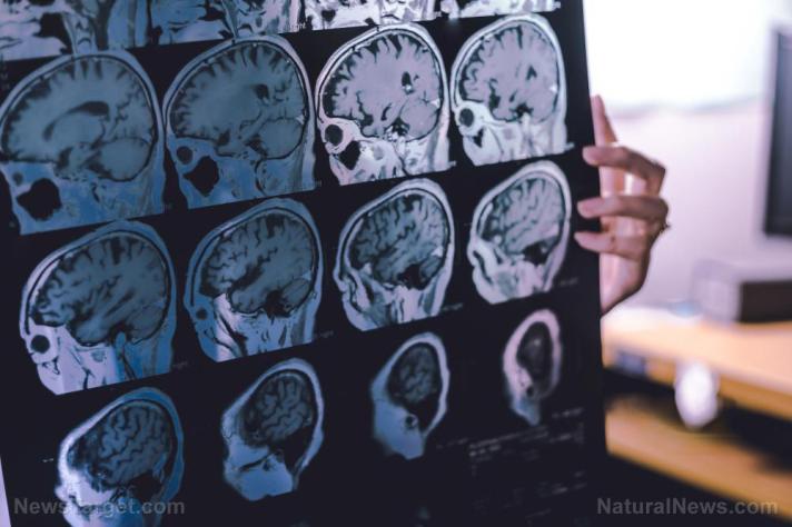 COVID jabs linked to 2,500% increased risk of early onset dementia