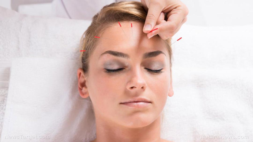 Acupuncture-Treatment