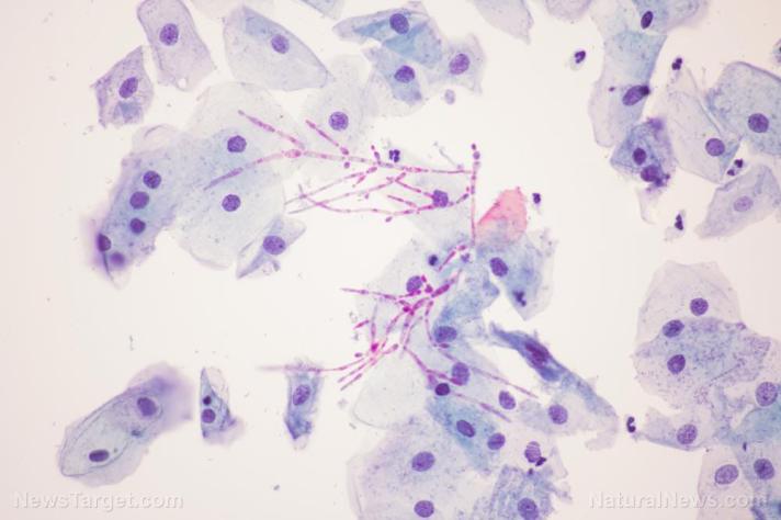 Antibiotics Cause Health Problems and Candida Overgrowth