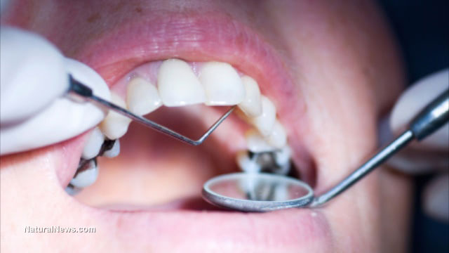 Dental fillings are raising mercury in blood to alarming levels