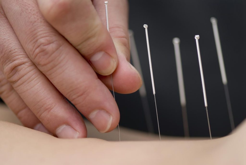 Electroacupuncture found to improve blood flow and skin temperature in patients with poor blood supply to the heart