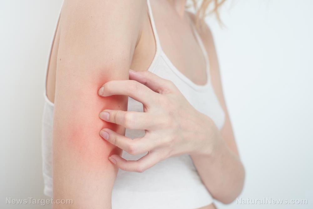 5 Natural treatments for eczema