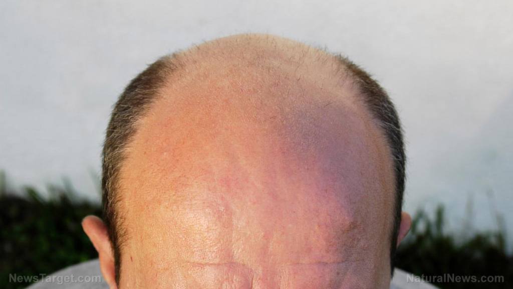 Want to go bald? Get a covid “vaccine!”