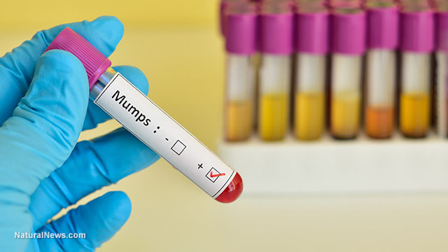 Just like covid, the vast majority of mumps cases occur among the vaccinated