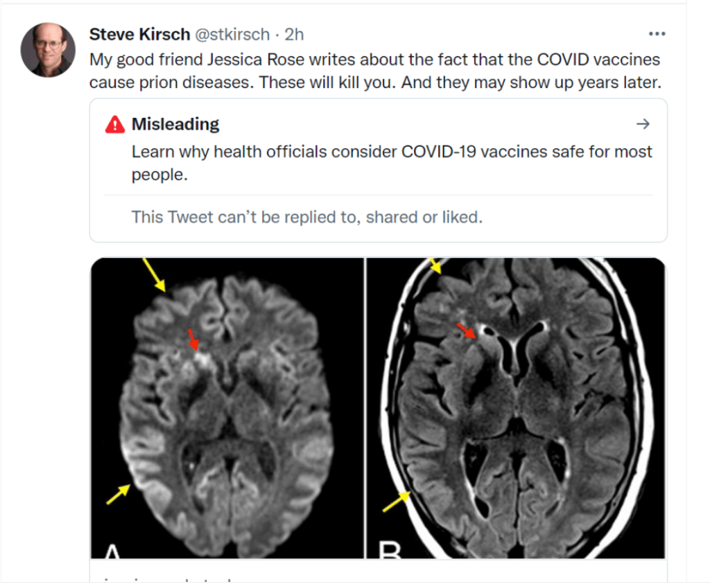 covid vaccines cause prions disease