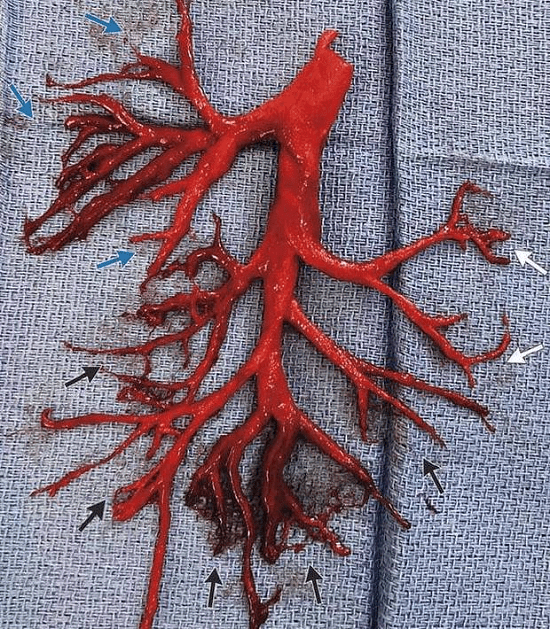 taken from a pre-covid patient in 2018, shows what a large, intact blood clot can look like