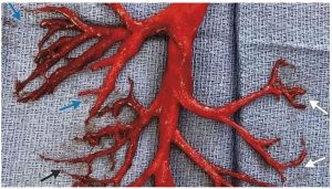 blood clot veins