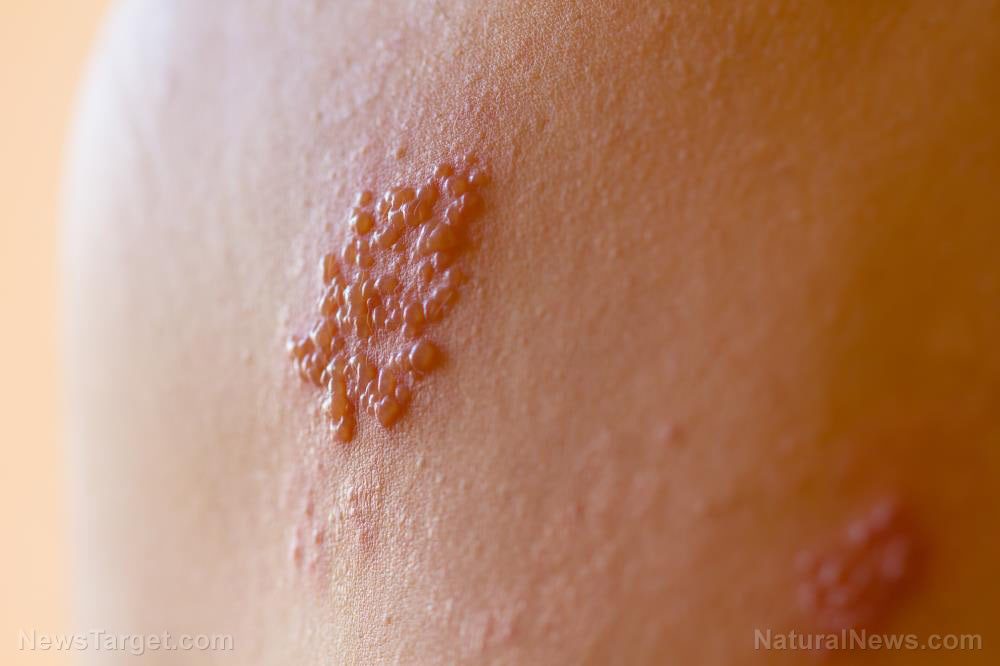 Federal govt. data indicates COVID-19 vaccines increase cases of shingles by more than 4000%