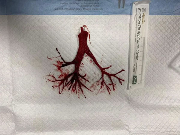 intact blood clot terminally extubated covid-patient