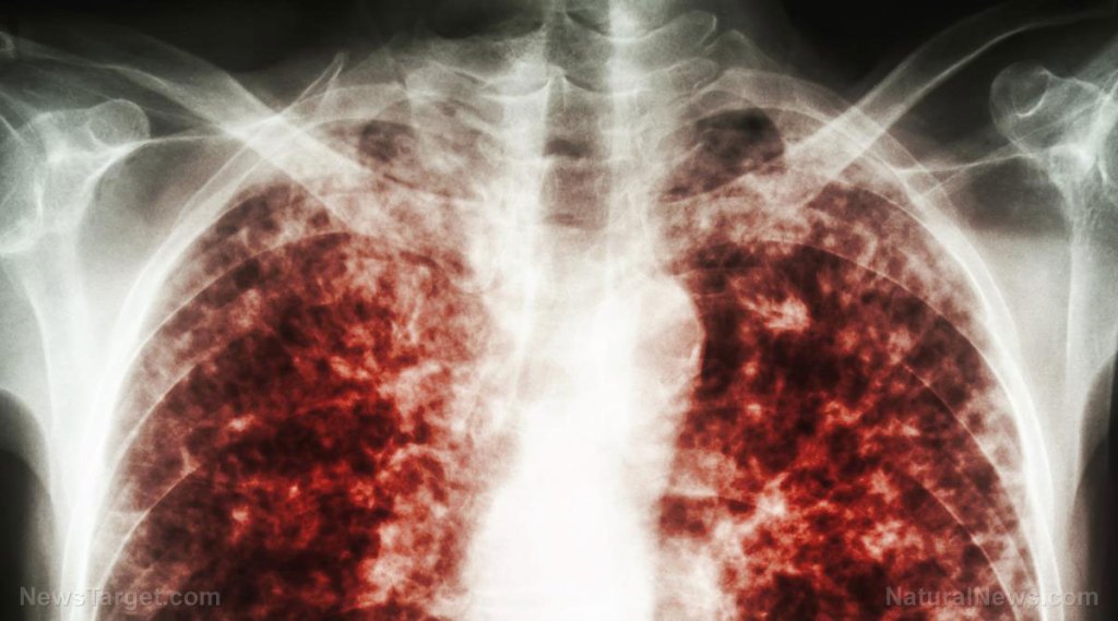 BIOWEAPONIZED CHILDREN: Tuberculosis-infected illegal alien children deliberately released across 44 states by the Biden regime