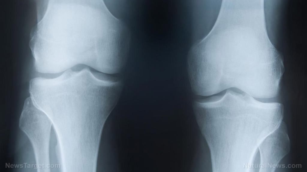 One month after receiving second COVID injection, woman develops psoriatic arthritis