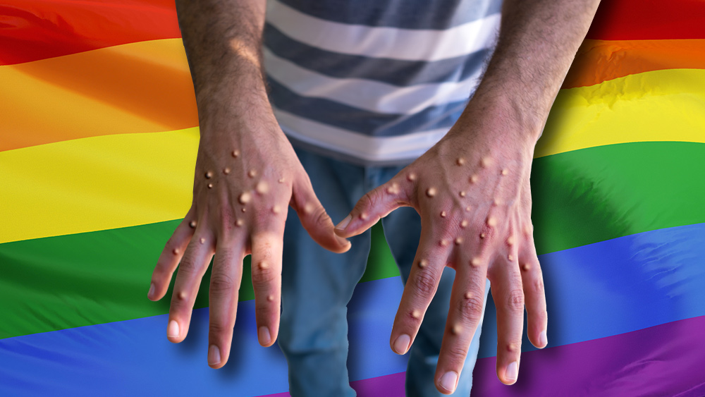 Monkeypox is a gay disease spread by seminal fluid, not merely skin contact, study finds