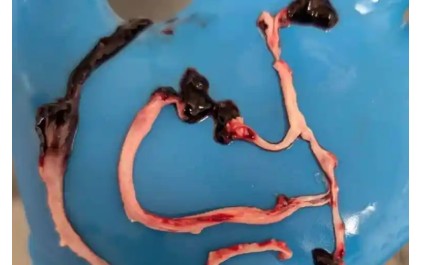 CLOT SHOT PLANDEMIC UNFOLDING: Fibrous, rubbery clots caused by covid injections have prion-like seeding activity